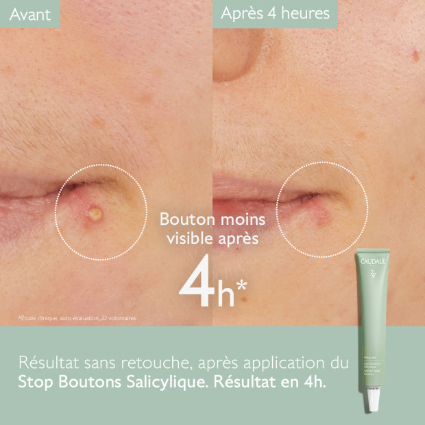 Caudalie VINOPURE Stop boutons salycilique, 15ml | Parashop.com